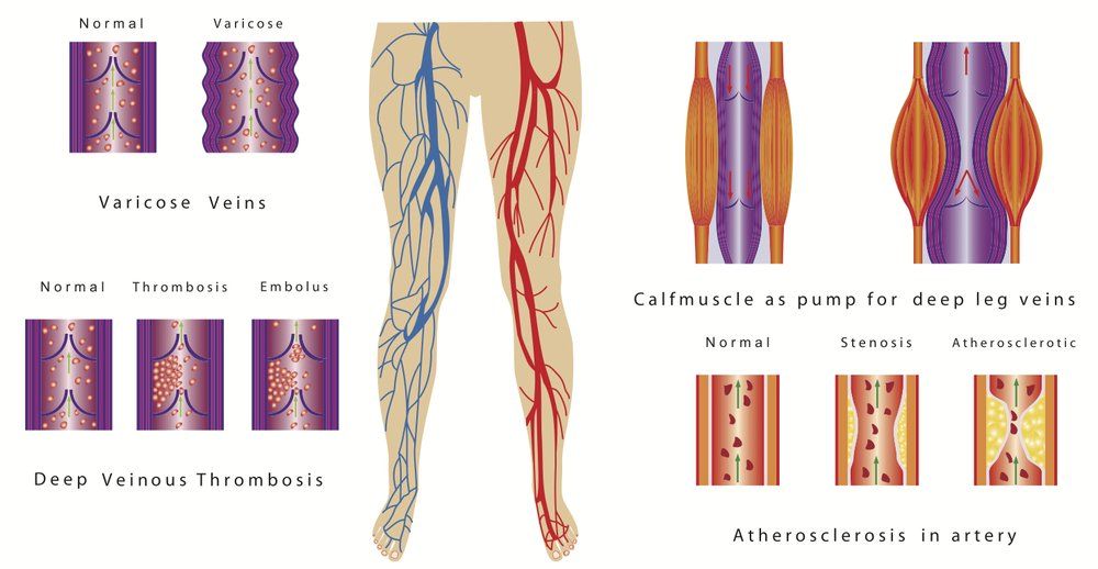 تفاوت ترومبوز و ترومبوفلبیت