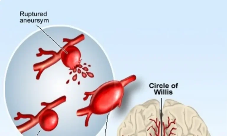 آنوریسم مغزه پاره شده