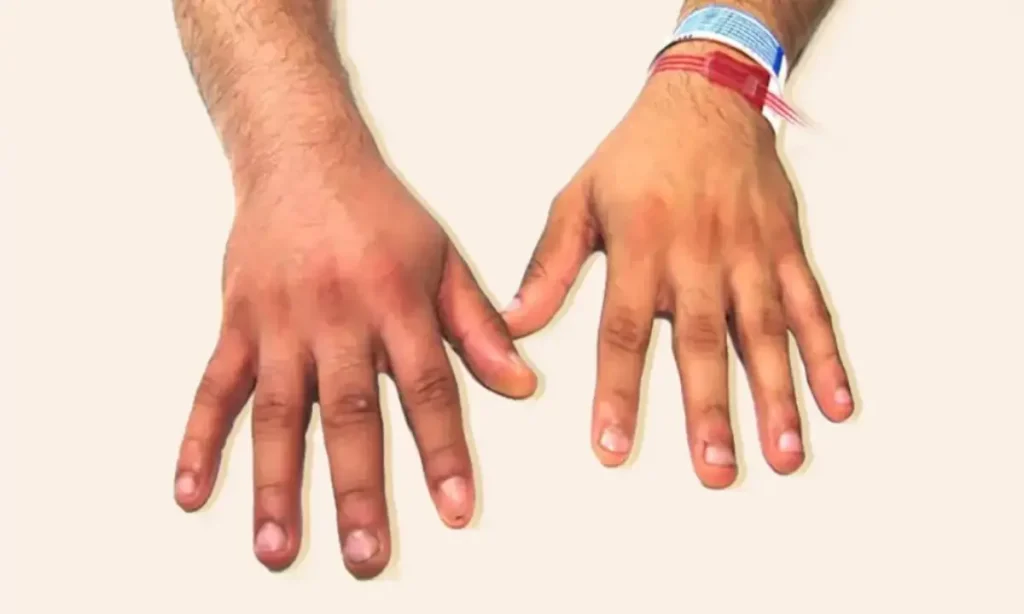 فرق ترومبوز و ترومبوفلبیت چیست