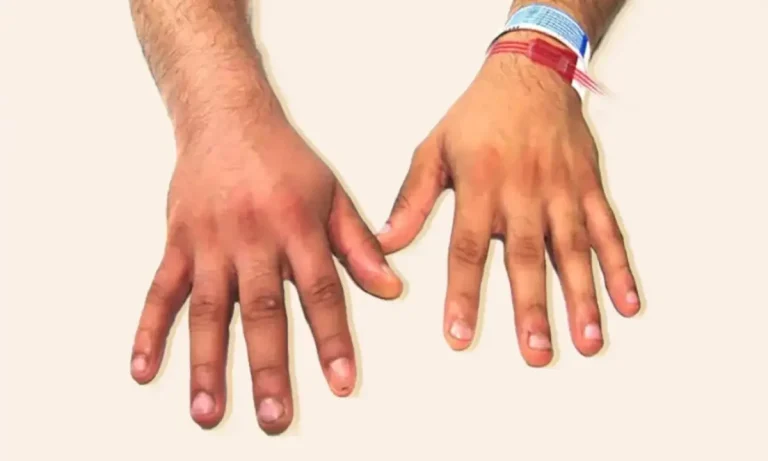 فرق ترومبوز و ترومبوفلبیت چیست