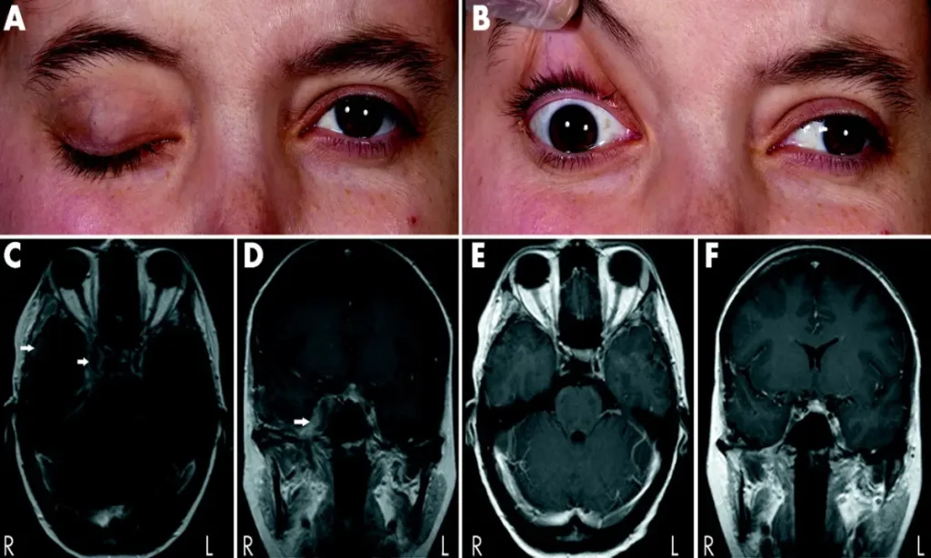 ترومبوز سینوس کاورنوس
