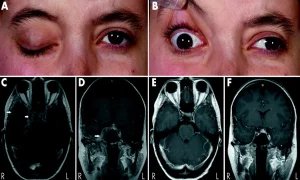 ترومبوز سینوس کاورنوس
