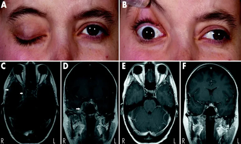 ترومبوز سینوس کاورنوس