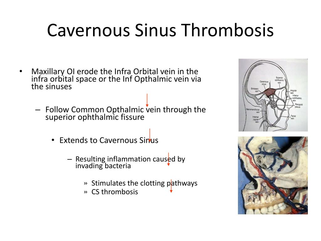 cavernous sinus thrombosis1 l
