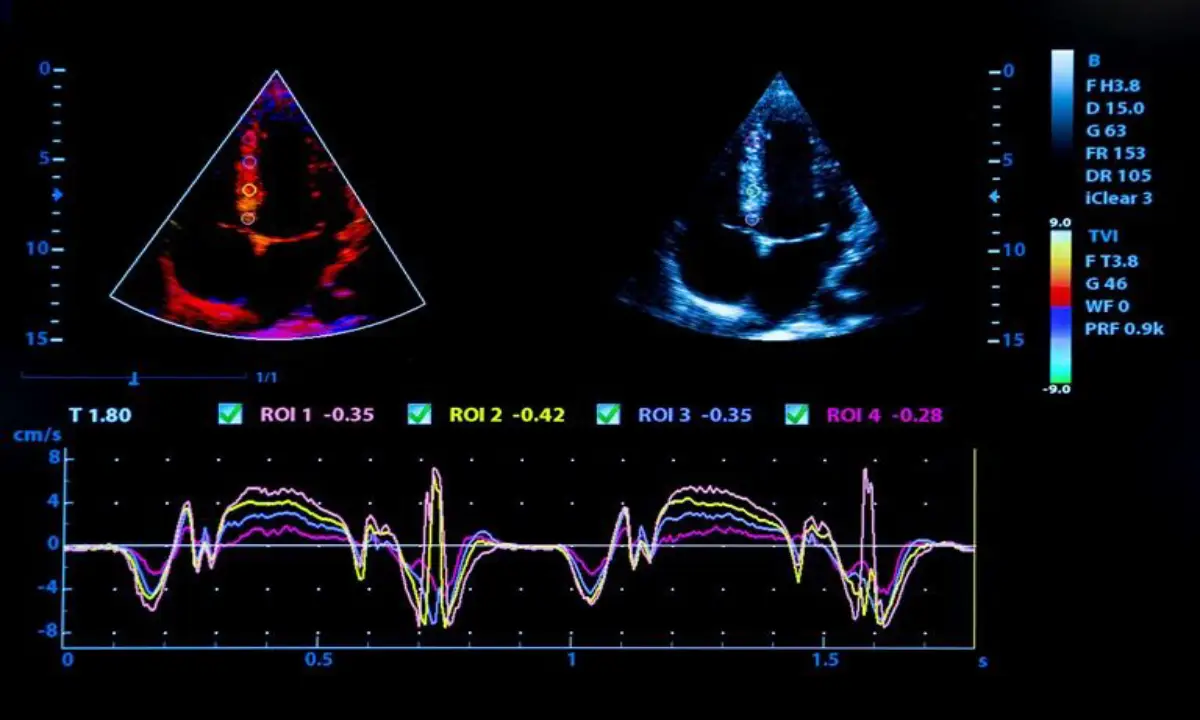 اکوکاردیوگرافی قلب