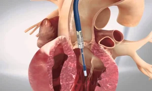 جراحی قلب چیست؟