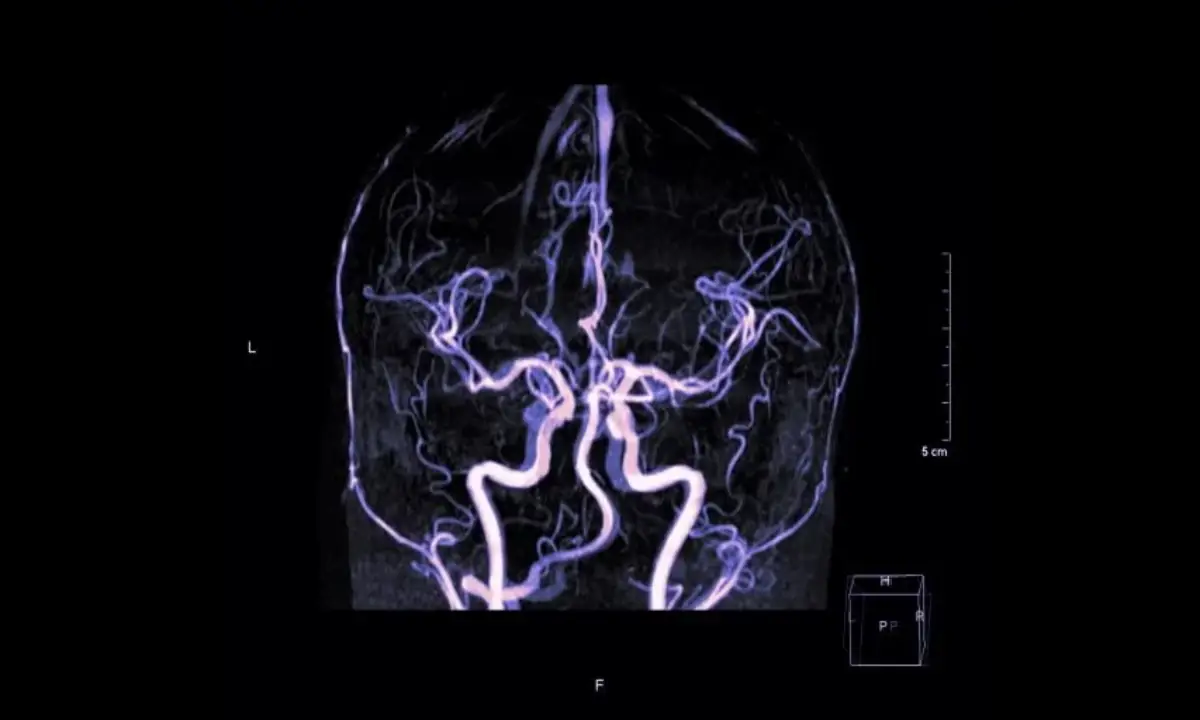 آیا آنوریسم مغزی باعث مرگ میشود