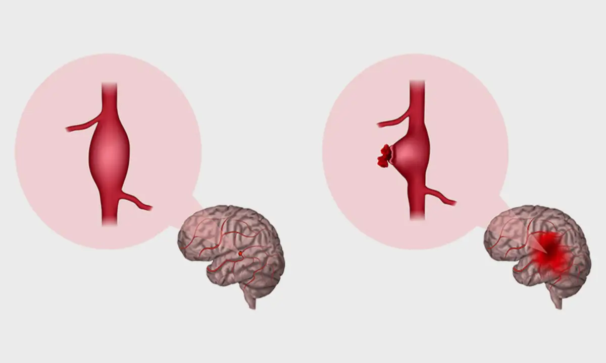 از علائم آنوریسم مغزی پاره نشده