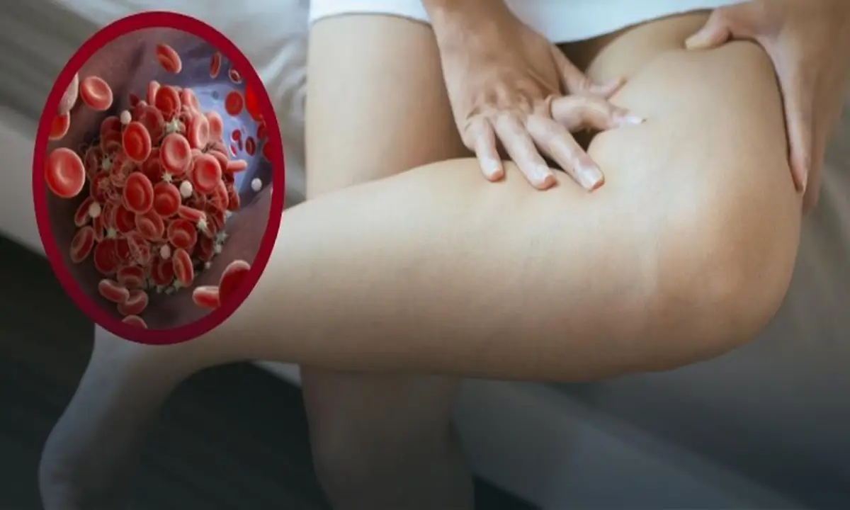 درمان ترومبوز پا