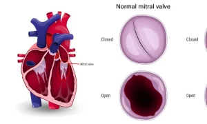 تنگی دریچه میترال